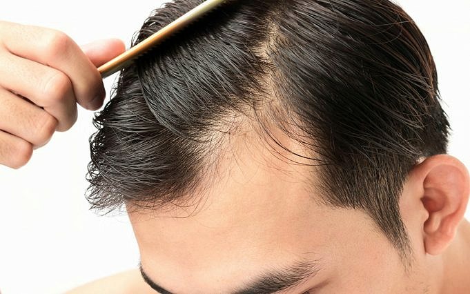 Wie Man Haare An Der Kahlen Stelle Nachwachsen Lässt. 2 Behandlungen Gegen Haarausfall Bei Männlichem Haarausfall